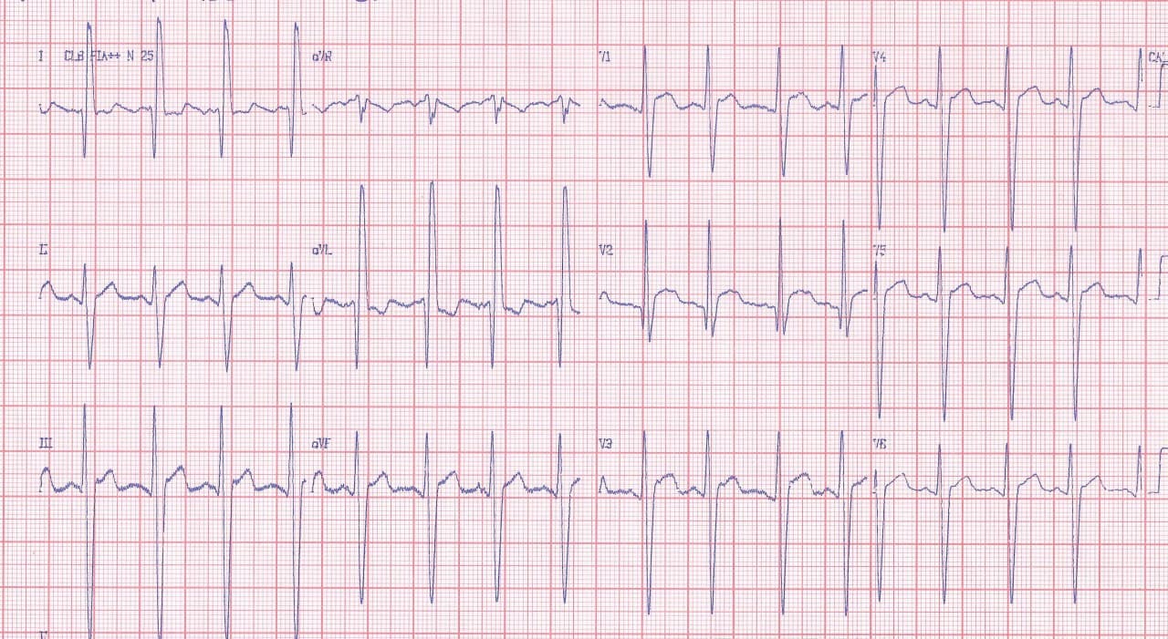 Paciente de 18 años con cuadro de insuficiencia cardíaca en clase III por ser portador de distrofia muscular de Duchenne