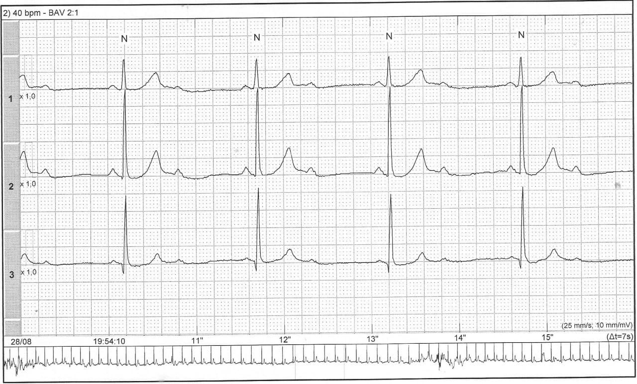 Mujer de 69 años que presenta síntomas presincopales por BAV 2:1 que evoluciona a BAVC requiriendo colocación de MPT que produce perforación y derrame pericárdico con buena evolución ulterior