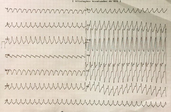Hombre de 64 años con serología reactiva para Chagas con cuadro de inestabilidad hemodinámica por presencia de TV subepicárdica