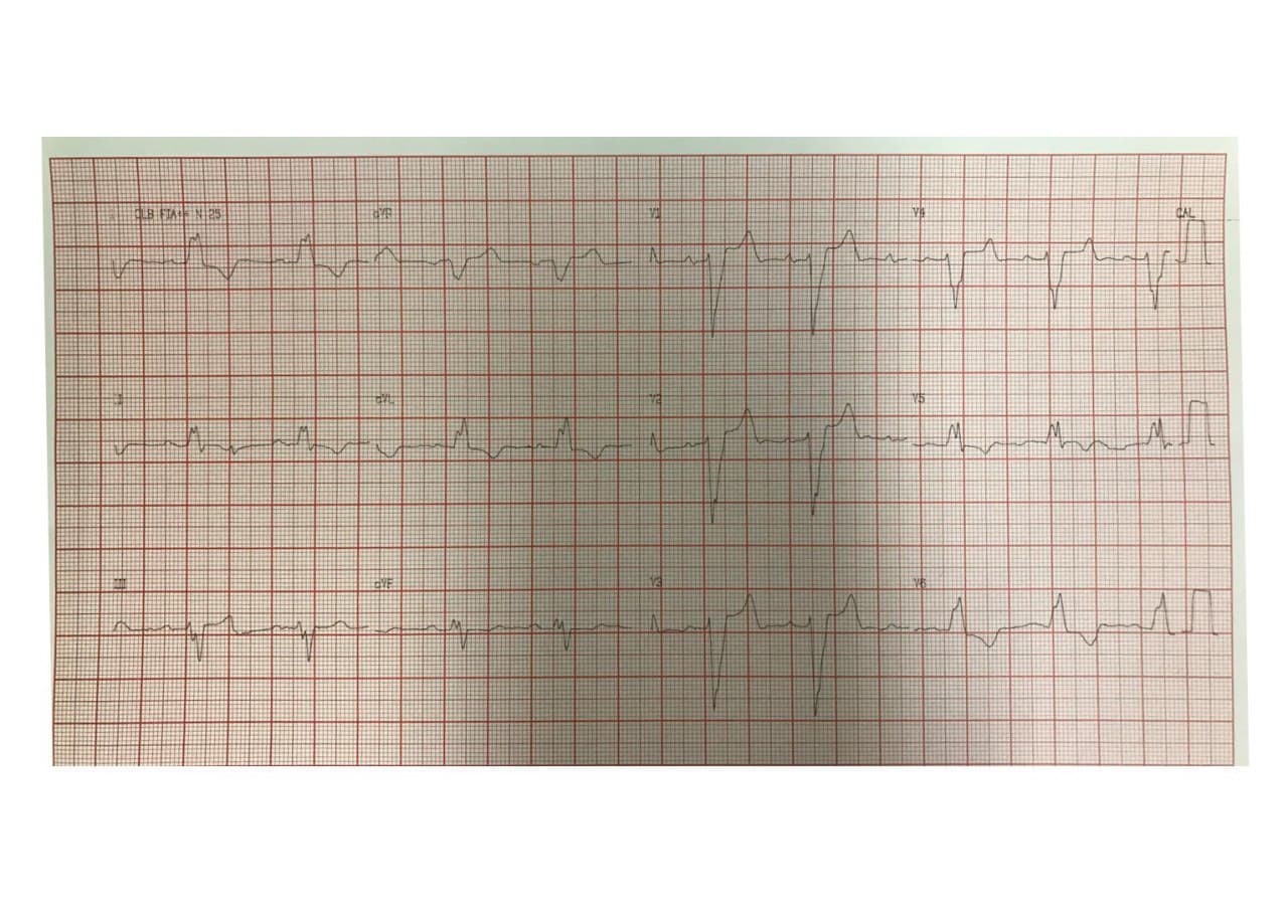 Hombre de 60 años con múltiples factores de riesgo que presenta disnea progresiva atribuible a miocardiopatía dilatada isquémica con presencia de BCRI con signo de Cabrera, compromiso de DA y CD, Fey de 23% y dilatación de VI
