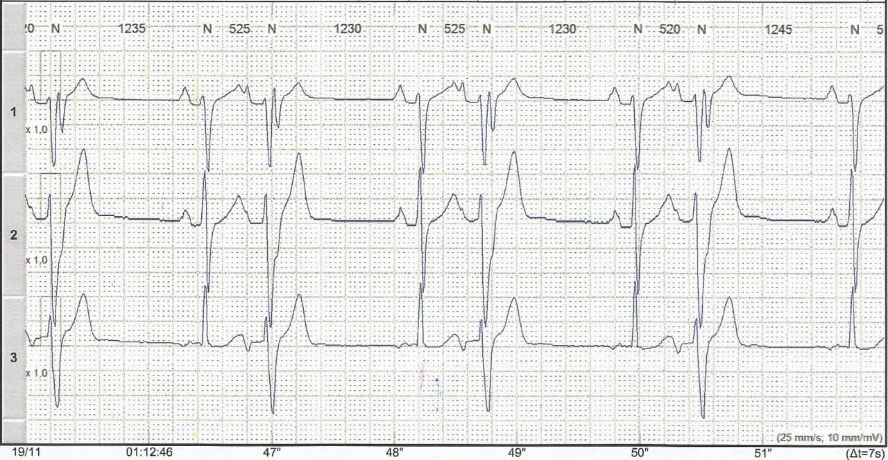 Paciente de 57 años que refiere palpitaciones originadas en extrasístoles auriculares, episodios de TA y aleteo auricular con y sin aberrancia