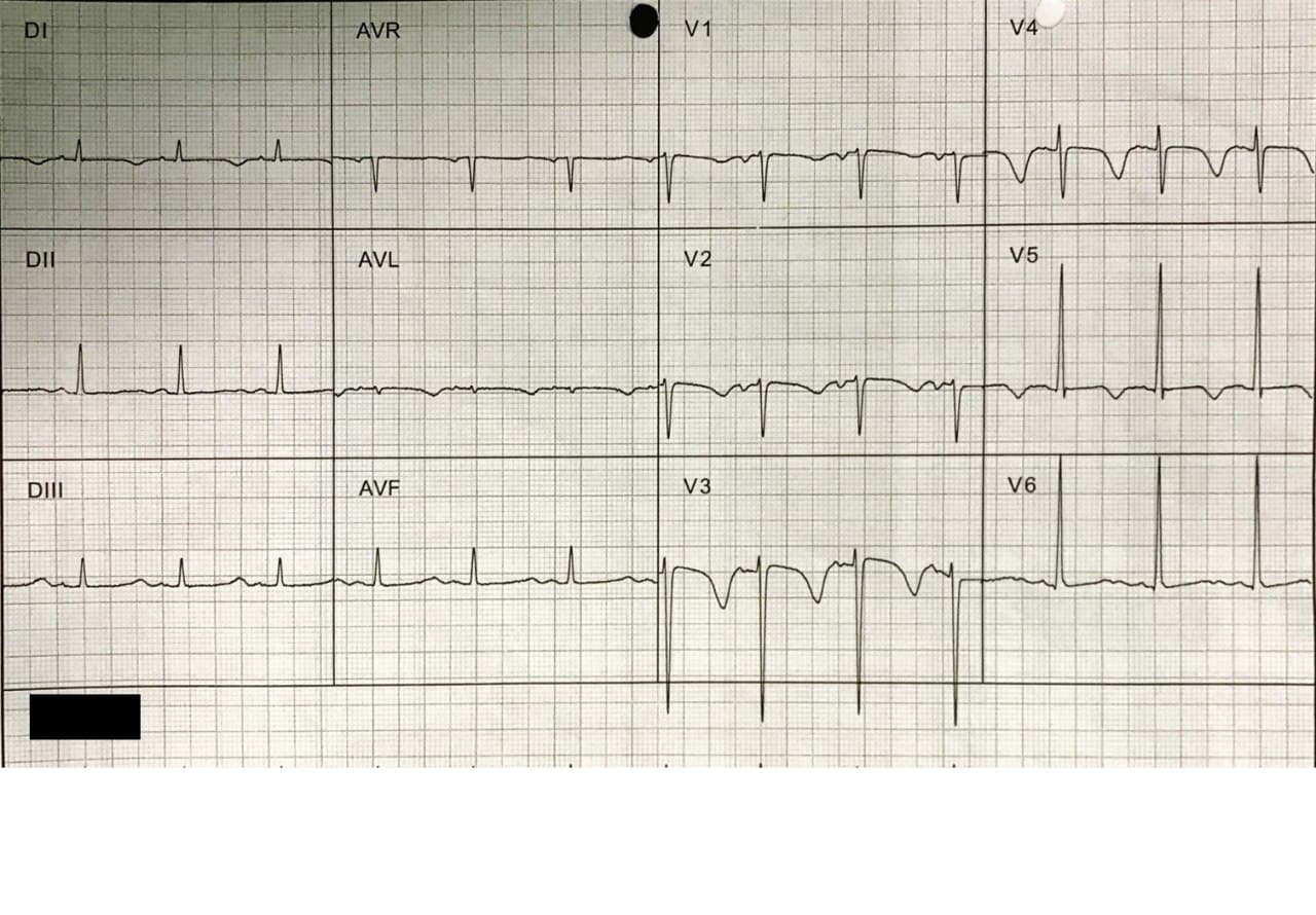 Mujer de 65 años con antecedentes de tiroidectomía que refiere malestar general y en la que se constata hipocalcemia que se corrige paulatinamente