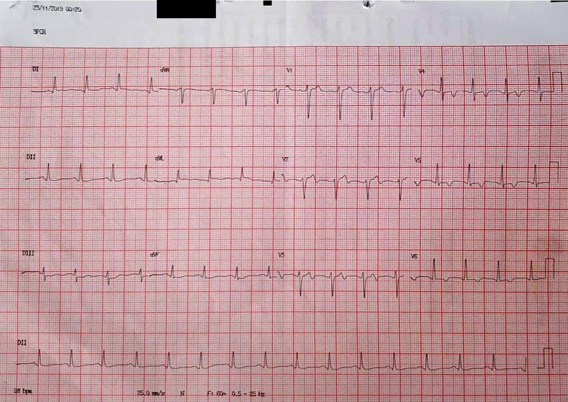 Paciente de 55 años que presenta episodio de angor prolongado determinado por SCA originado en un hematoma subintimal de la DA constatado por IVUS