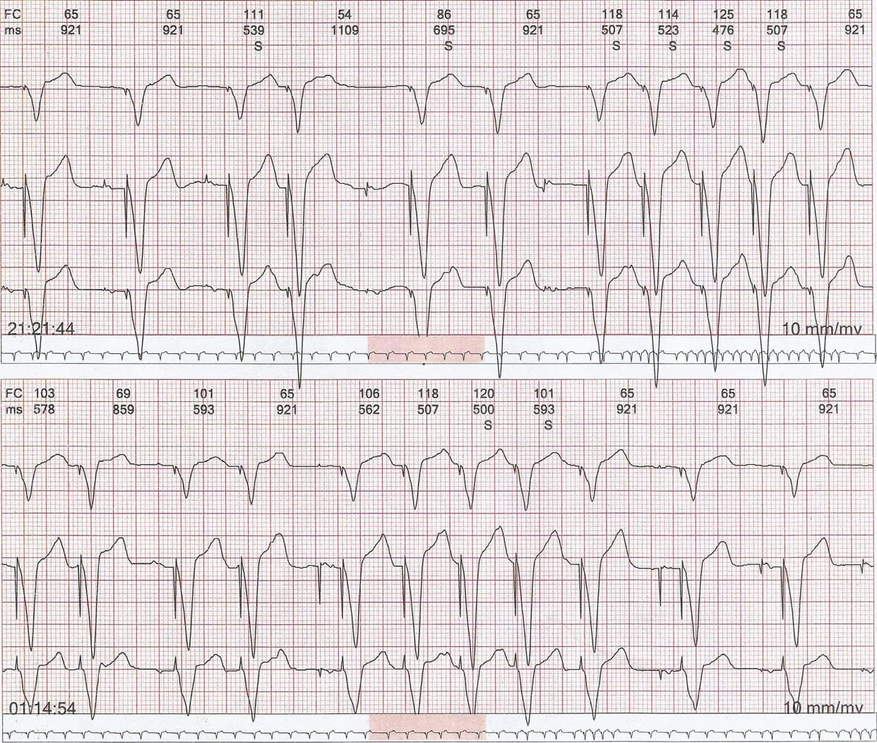 Paciente portador de MP bicameral y palpitaciones atribuibles a taquicardia mediada por MP y TPSV