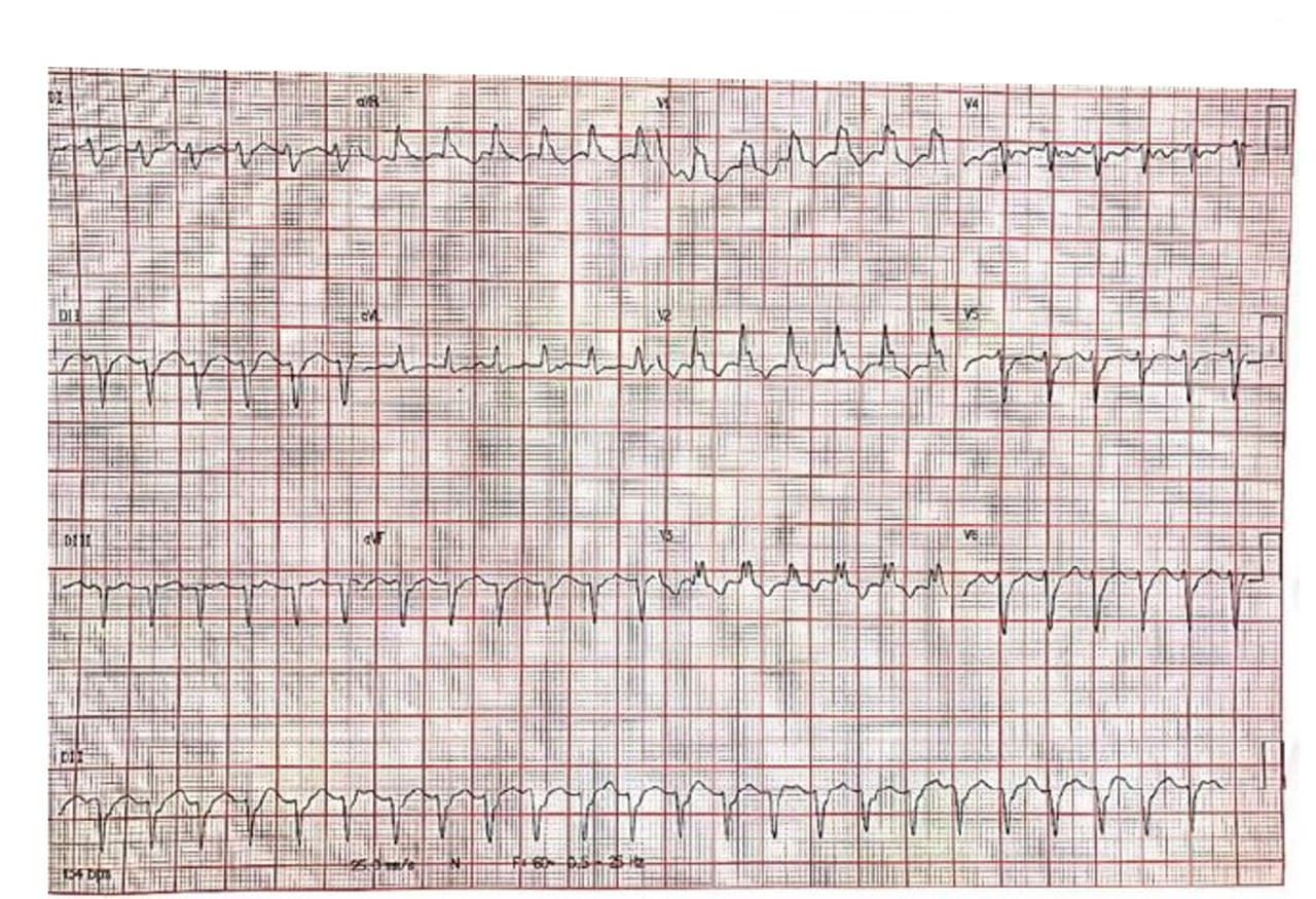 Paciente masculino de 42 años que post epidodio gripal desarrolla disnea progresiva y palpitaciones por presencia de TV fascicular