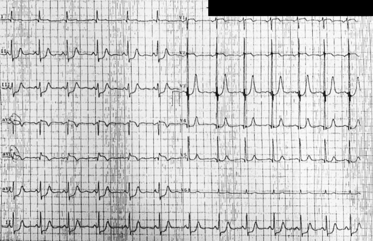 Hombre de 55 años que presenta episodios de angor de reposo por severa enfermedad coronaria con obstrucción de 100% de Cx