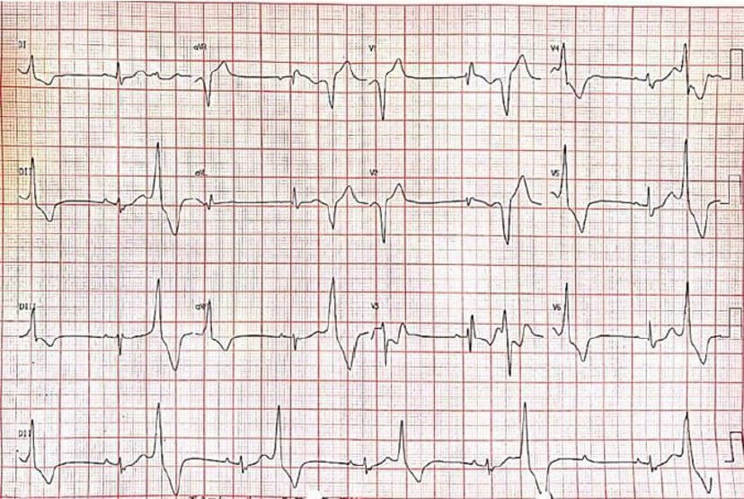 Mujer de 32 años con disnea progresiva y malestar general desde hace dos años que presenta bloqueo 2:1 asociado a BCRD, con ecocardiograma normal y serología para Chagas no reactiva, en espera de RNM