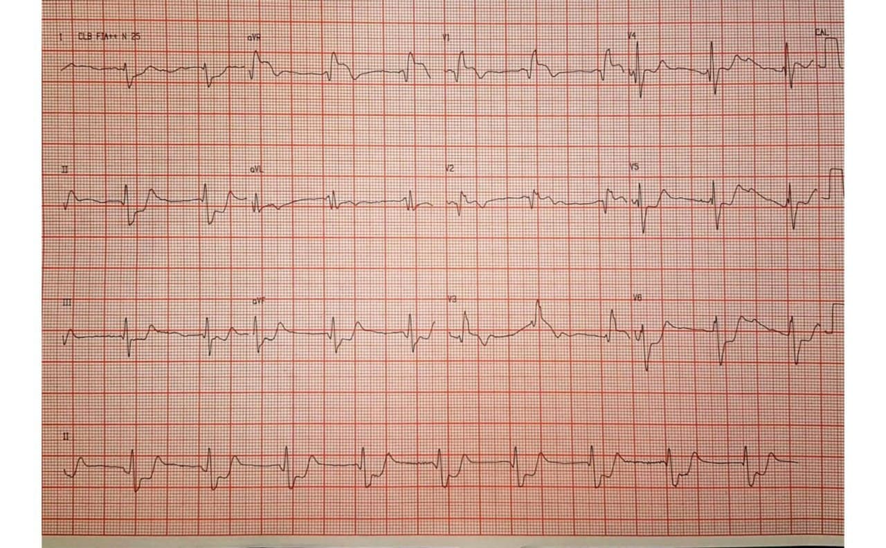 Hombre de 52 años que presenta angor prolongado luego de consumo de cocaína por presentar severas lesiones coronarias difusas incluyendo TCI con trombos