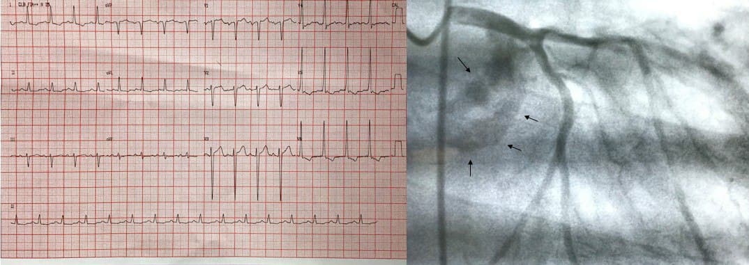 Mujer de 66 años con disnea y síncope, con presencia de soplo eyectivo de estenosis aórtica, cuyo ECG presenta signos de HVI y sobrecarga sistólica