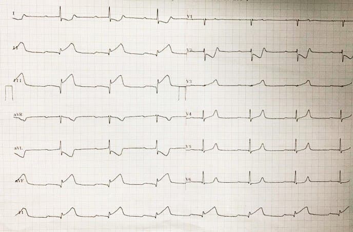 Mujer de 65 años portadora de IRC dialítica y enfermedad vascular periférica que presenta episodio de angor prolongado cursando IAM inferior e infarto auricular
