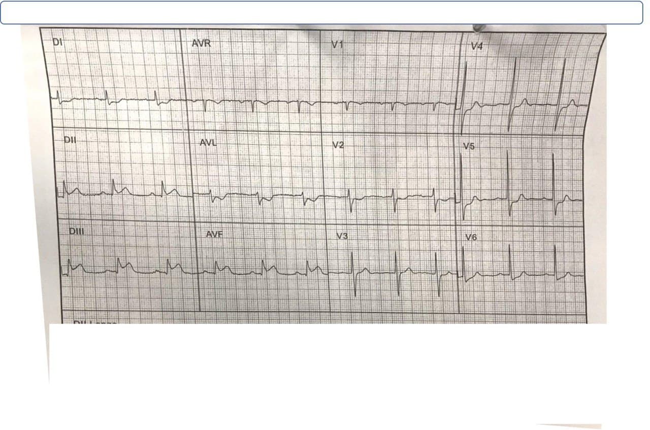 Hombre de 77 años que presenta angor prolongado por SCA que es tratado con tenecteplase y que posteriormente desarrolla dolor abdominal por presentar hematoma subcapsular hepático