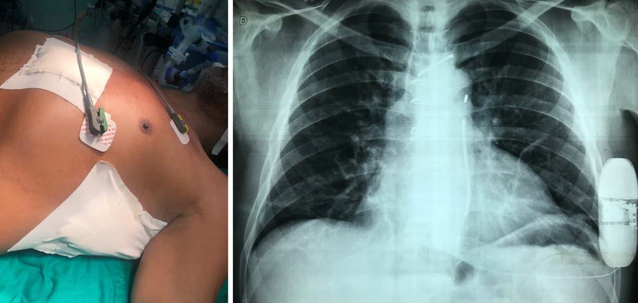 Paciente de 47 años con DAI por TV que desarrolla endocarditis a punto de partida en el dispositivo lo que motiva su reemplazo por un CDI subcutáneo