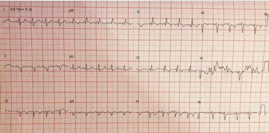 Paciente masculino de 70 años con disnea y síncope por presentar TEP con fracaso de terapia trombolítica