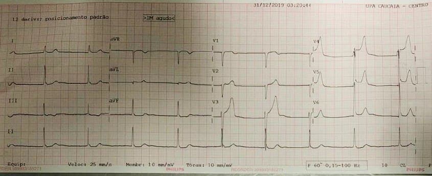 Hombre de 52 años que presenta angor prolongado con patrón de Winter en el ECG por oclusión proximal de la DA