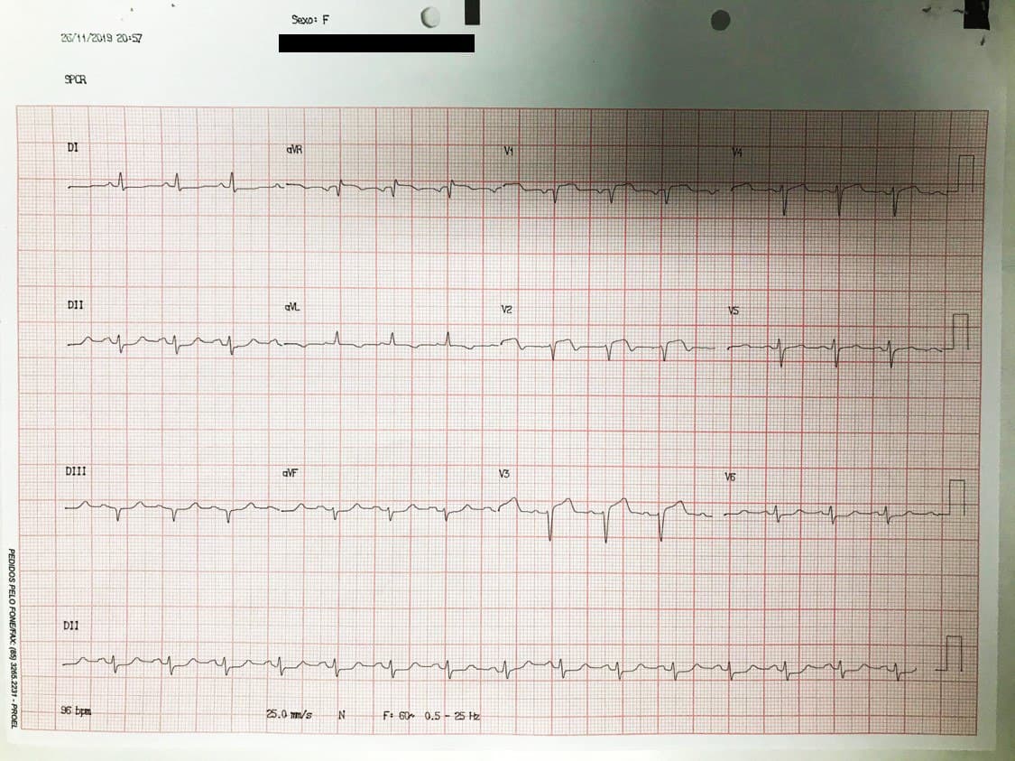 Mujer de 73 años hipertensa y diabética con antecedentes de implantes de by pass de safena a DA y Cx que presenta angor prolongado por trombo en puente de safena a DA
