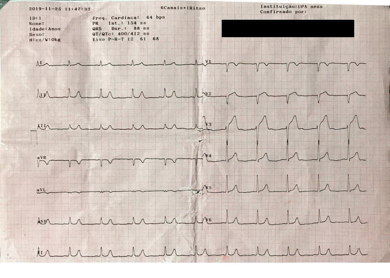 Hombre de 48 años consumidor de alcohol y drogas duras que presenta angor prolongado por lesión fija y trombo en DA