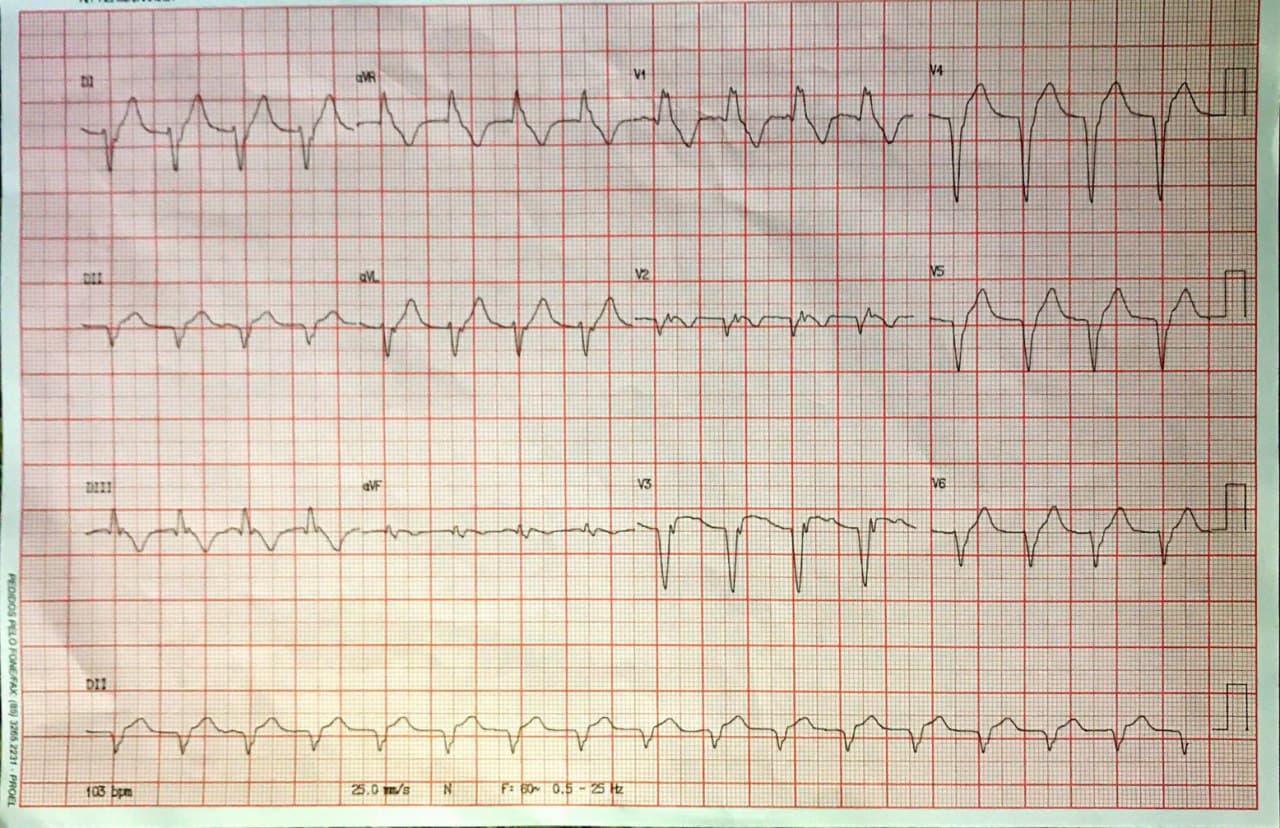 Paciente de 49 años que presenta angor prolongado por severa lesión con trombo en DA que es angioplastiada, presentándose un RIVA como expresión de la reperfusión