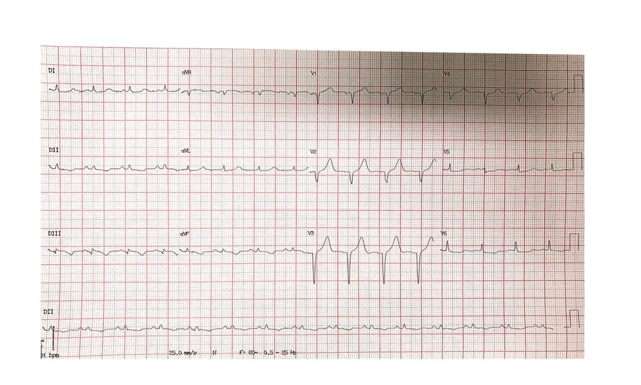Hombre de 52 años portador de enfermedad coronaria difusa con angor prolongado por SCA por presencia de suboclusión con trombo de Cx, vaso culpable