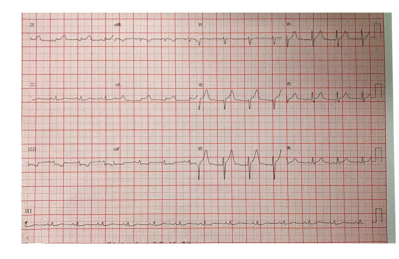 Hombre de 34 años sin antecedentes que presenta episodio de angor prolongado por la madrugada constatándose ausencia de lesiones angiográficas lo que permite establecer el diagnóstico de MINOCA
