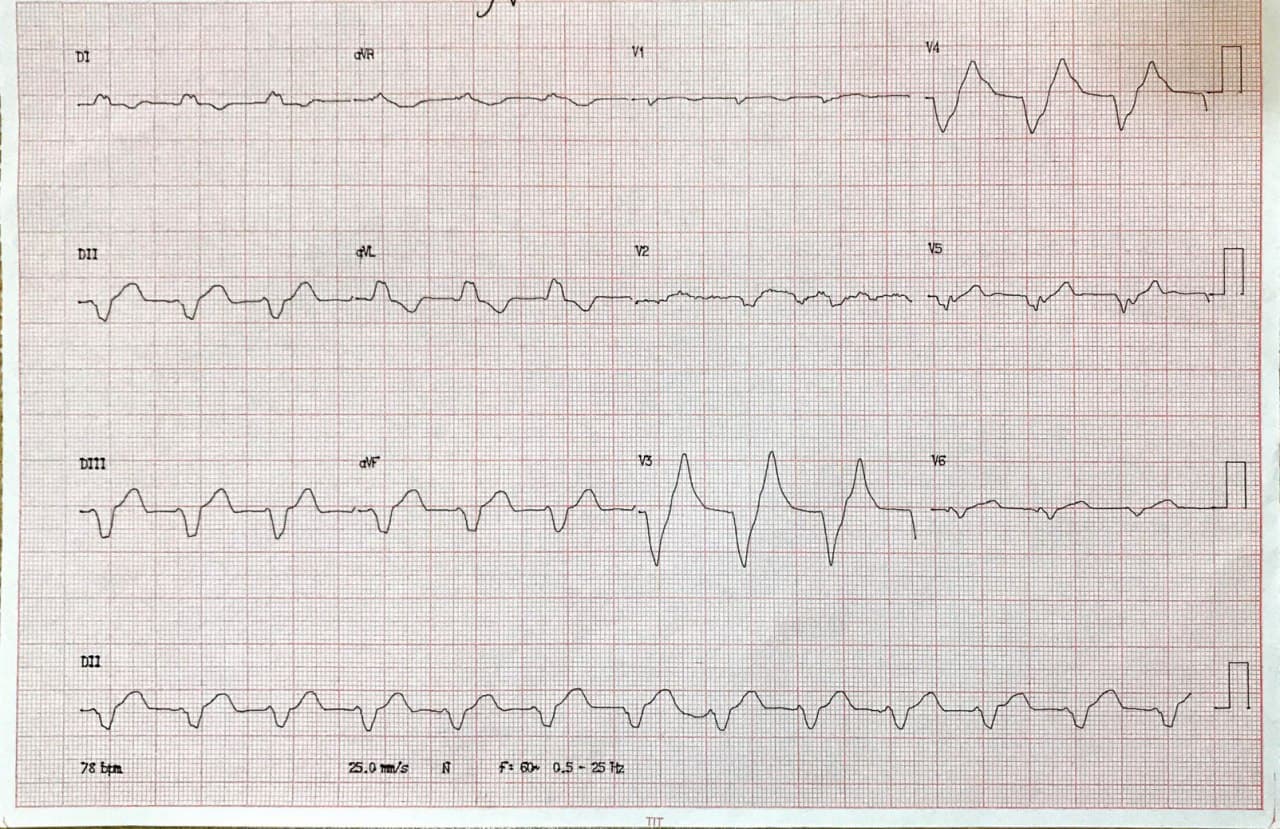 Paciente masculino hipertenso y diabético de 64 años con severa hiperkalemia