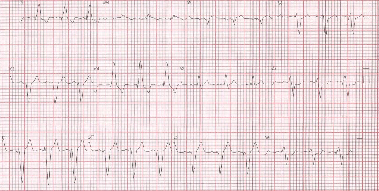 Paciente de 61 años con insuficiencia renal crónica no dialítica que presenta episodio de angor, ortopnea, DPN, edemas en MMII y plenitud gástrica portador de MP, que presenta signo de Sgarbossa + por compromiso de la DA con trombo