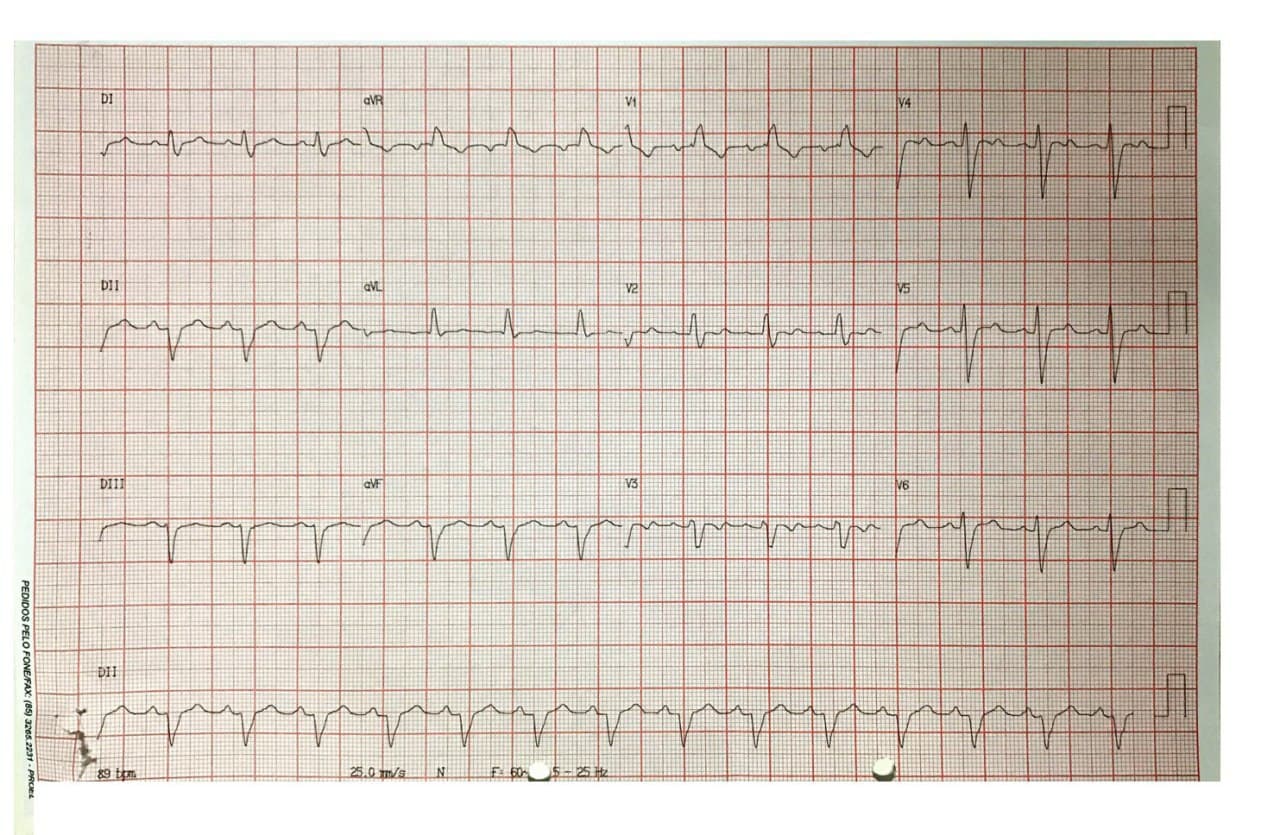 Paciente masculino de 51 años con serología reactiva para Chagas que presenta precordialgia atípica con cambios de movilidad segmentaria  ínferolateral en ecocardiograma