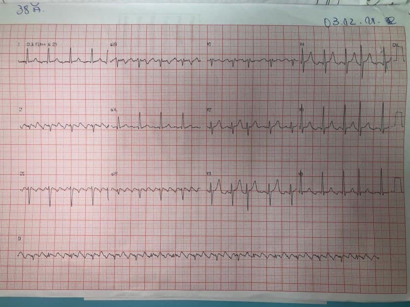 Masculino de 37 años con palpitaciones y disnea de larga data que empeora, atribuible a presencia de aleteo auricular que determina evolución a taquimiocardiopatía que mejora luego de ARF
