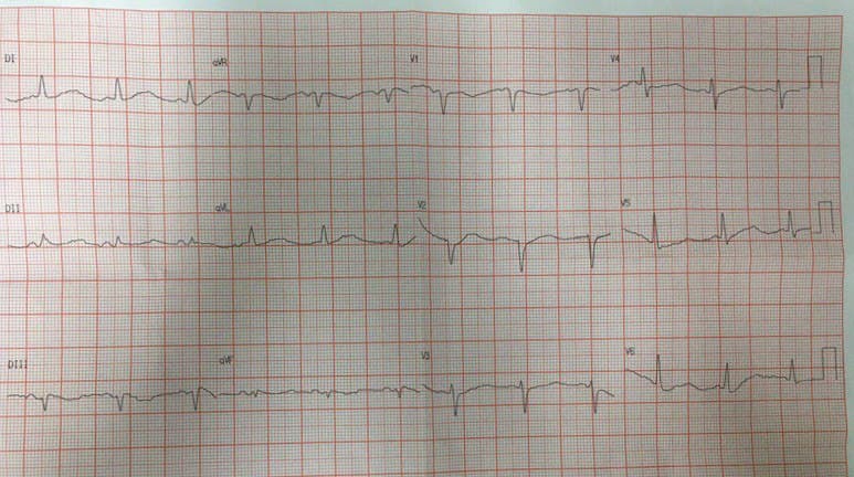 Paciente de 50 años en tratamiento con antidepresivos que presenta vómitos y síncope convulsivo con severa hipokalemia e hipomagnesemia que determinan QT largo