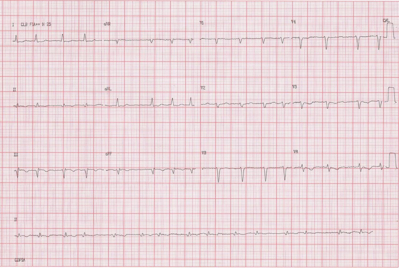 Mujer de 53 años, HTA y DBT de larga data, portadora de enfermedad coronaria difusa con FA crónica que presenta descompensación concomitante a desarrollo de AA 2:1 con aberrancia y signos de hiperpotasemia