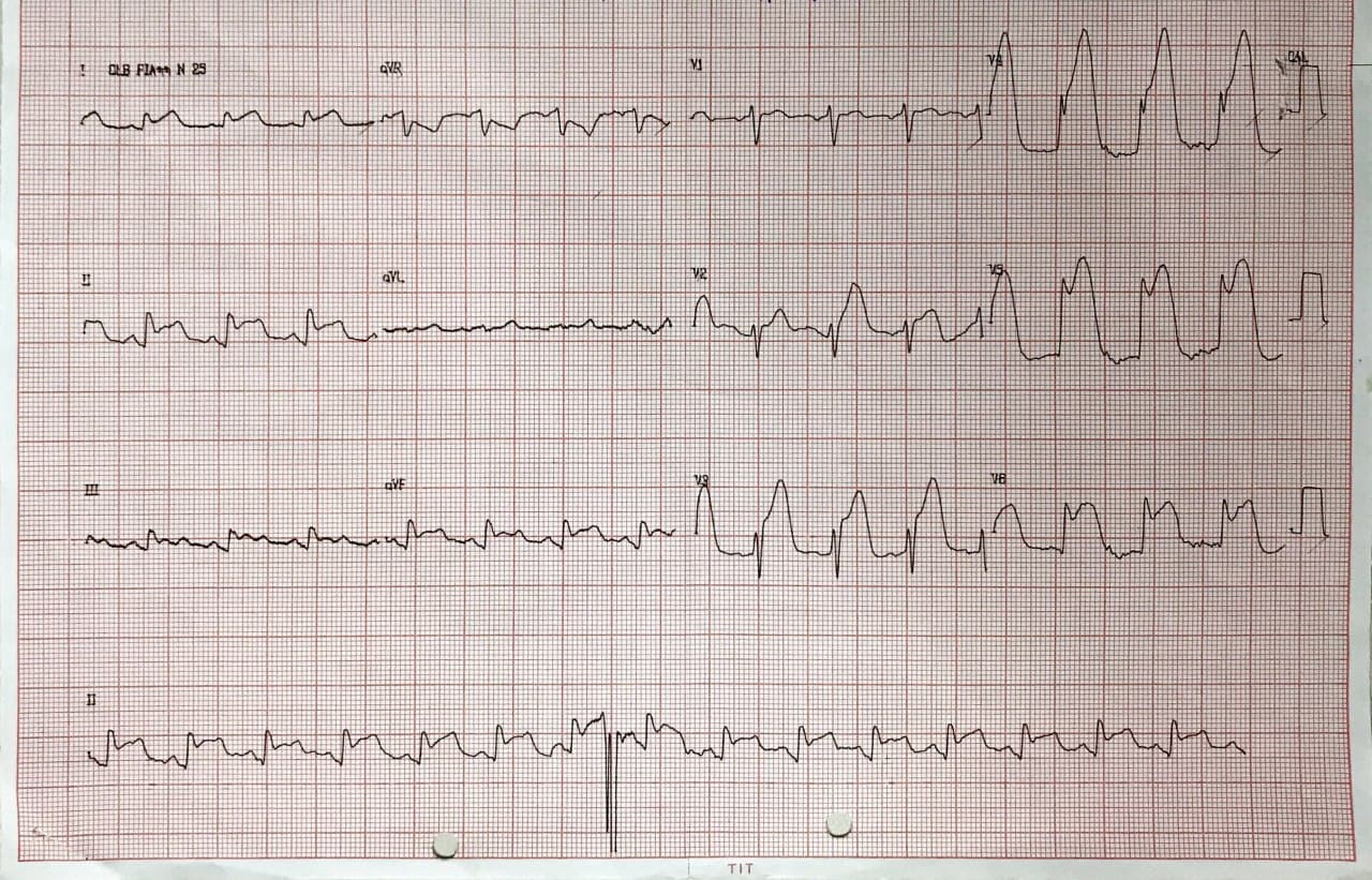 Hombre d 61 años, fumador, alcoholista y consumidor de cocaína, portador de miocardiopatía que presenta episodio de ángor prolongado en quién se detecta arteria marginal izquierda ocluida en el tercio distal con presencia de trombo, practicándose trombolisis