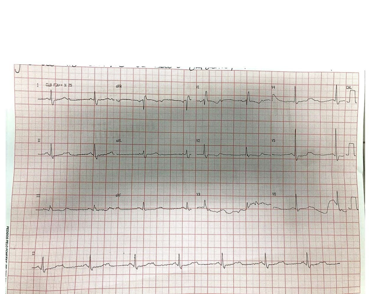 Mujer de 79 años con mareos frecuentes que presenta BAV 2:1 asociado a BCRD con indicación de MP