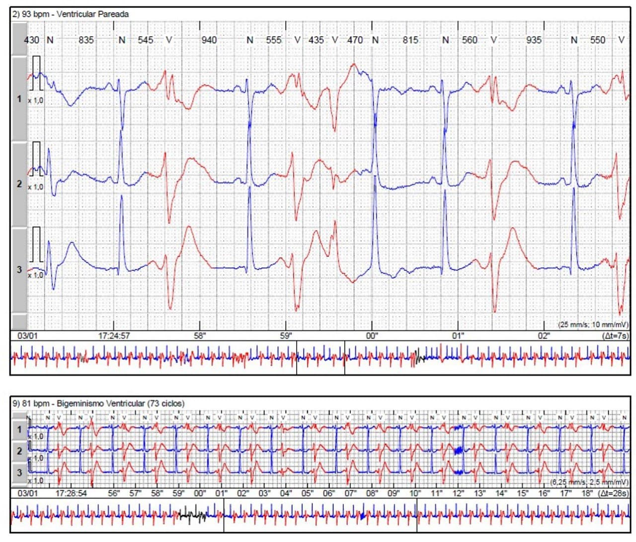 Mujer de 49 años tratada con antidepresivos que presenta síncope atribuible al desarrollo de TdP