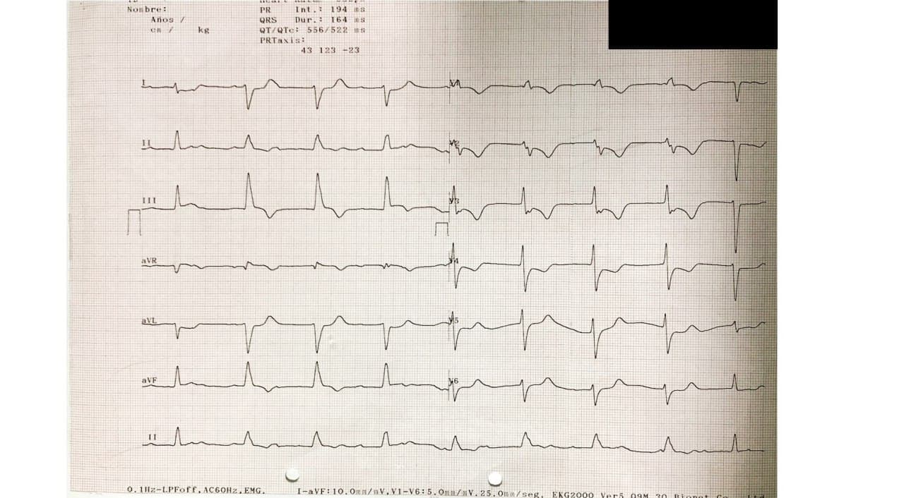 Hombre de 66 años con vómitos y sudoración que presenta RIVA como expresión de  reperfusión por presencia de oclusión con trombo de CD