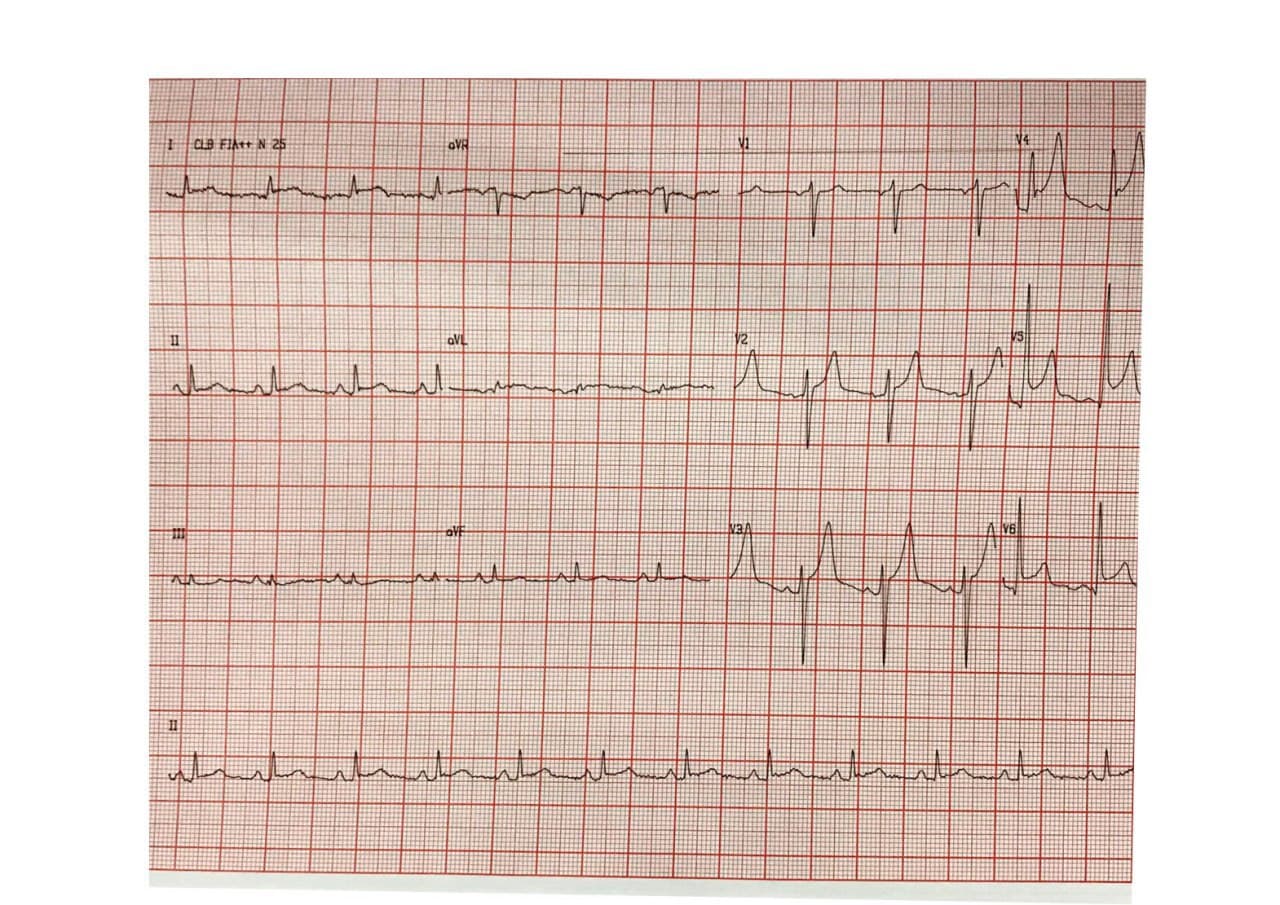 Paciente masculino de 56 años que refiere ardor precordial en quién se constata oclusión de primera diagonal