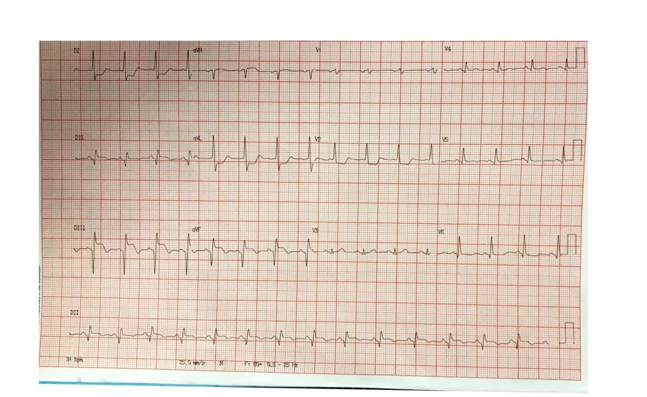 Paciente masculino diabético de 49 años que presenta SCA por oclusión con trombo en tercio medio de CD que se complica con ruptura cardíaca interna por CIV