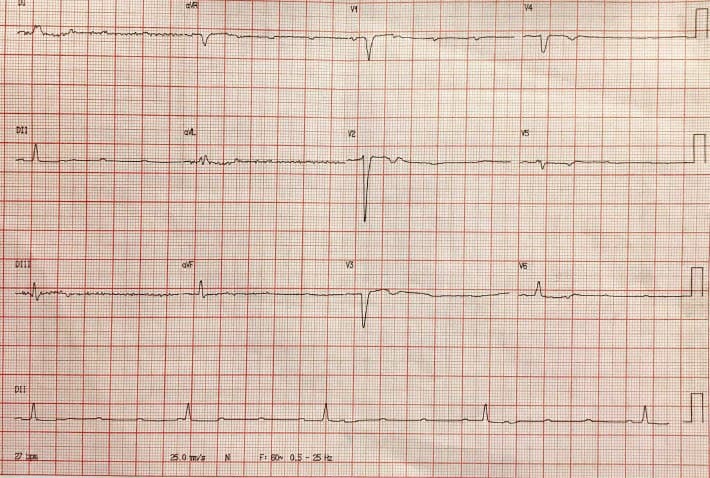 Paciente masculino de 43 años con atc de linfoma de Hodking tratado hace 18 años con quimio y radioterapia que manifiesta disnea desde hace varios años con signos de insuficiencia cardíaca y BAVC presentando hipocinesia de cara inferior y dilatación del VI, constatándose compromiso de TCI, Cx DA y 1º diagonal