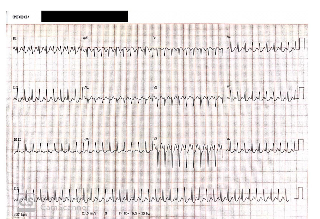 Embarazada de 25 años con gesta de 29 semanas que refiere palpitaciones por presencia de TRAV puesta de manifiesto por el supradesnivel en aVR debido a ondas P retrógradas