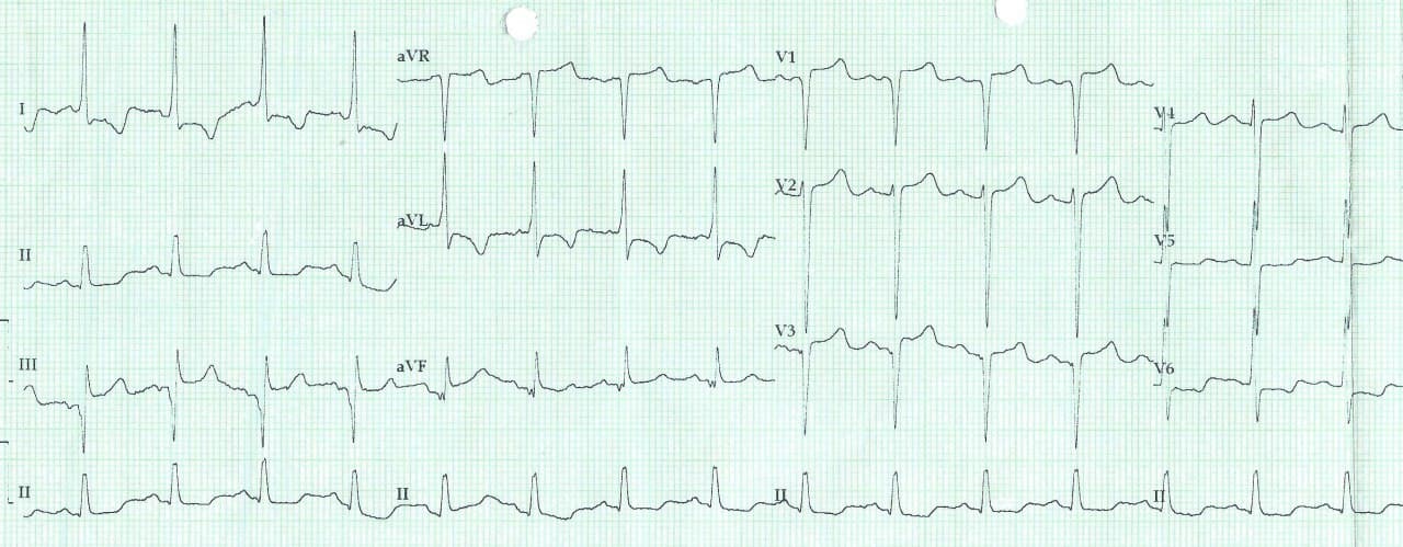 Mujer de 56 años con fuerte dolor precordial opresivo acompañado de vómitos, sudoración intensa y paresia de la extremidad superior derecha que presenta TEP bilateral