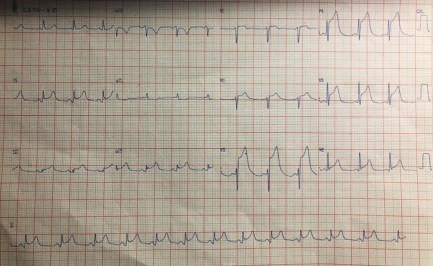 Hombre de 59 años con angor prolongado con cambios difusos del ST-T originados en oclusión con trombo en tercio medio de DA y puente miocárdico confirmados con IVUS