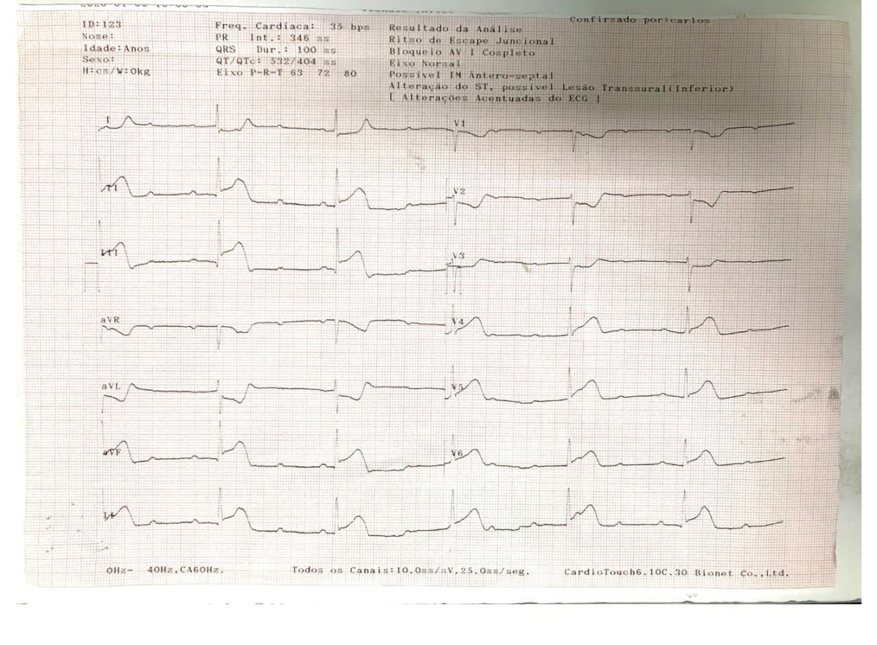 Mujer de 65 años que presenta IAMCEST ínferolateral por oclusión con trombo de CD que determina BAVC por compromiso de arteria de nódulo AV que desaparece luego de reperfusión