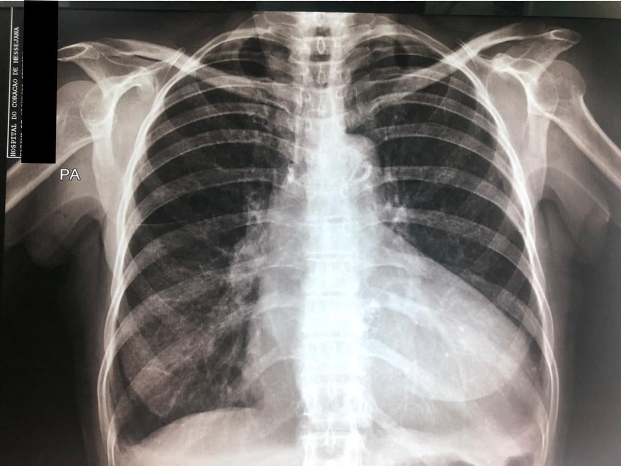 Hombre de 65 años con disnea progresiva de un año de evolución que presenta calcificación valvular aórtica que determina doble lesión a predominio de estenosis