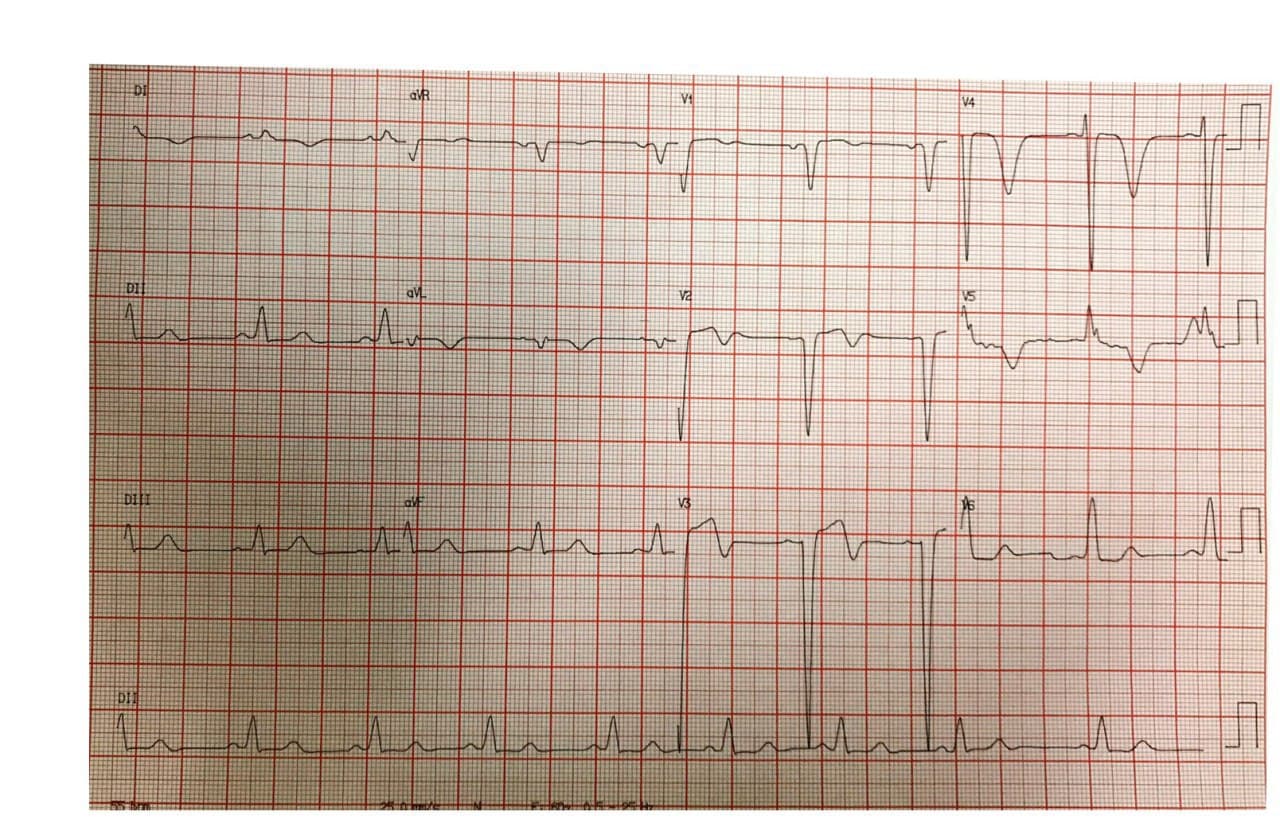 Hombre de 43 años con antecedentes de insuficiencia cardíaca que presenta disnea y mareos con presencia de miocardiopatía dilatada