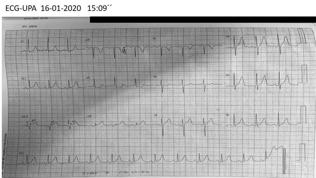 Mujer de 47 años con intenso episodio de ángor de reposo constatándose CCG normal e imágenes compatibles con miocardiopatía de Takotsubo