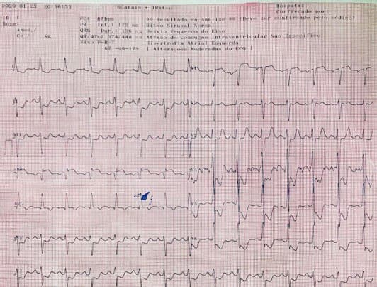 Paciente de 45 años en tratamiento dialítico por nefropatía hipertensiva que presenta isquemia circunsferencial y disección aórtica tipo A con evolución al óbito