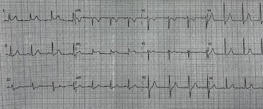 Paciente masculino de 23 años que comienza con dolor precordial, fiebre  y síntomas vagales atribuibles a la presencia de puente muscular que produce oclusión sistólica intermitente en tercio medio de DA