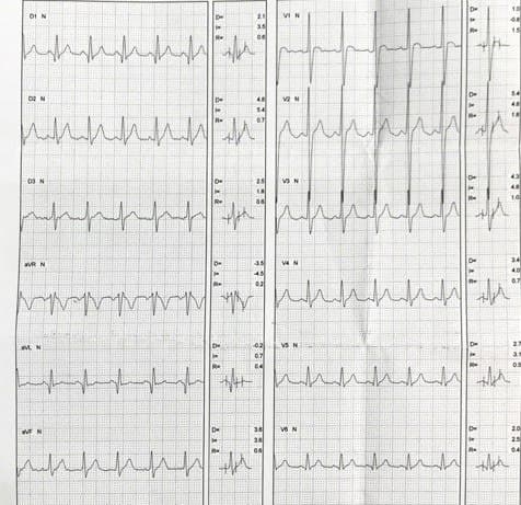 Paciente masculino de 24 años portador de distrofia muscular de Duchenne que presenta compromiso de pared ínferolateral y FAP
