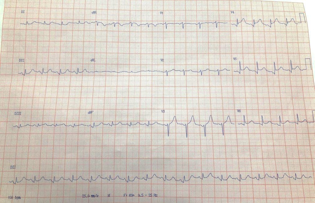 Mujer de 64 años, tabaquista con HTA y DBT que presenta angor prolongado constatándose CCG normal con imagen típica de miocardiopatía de Takotsubo