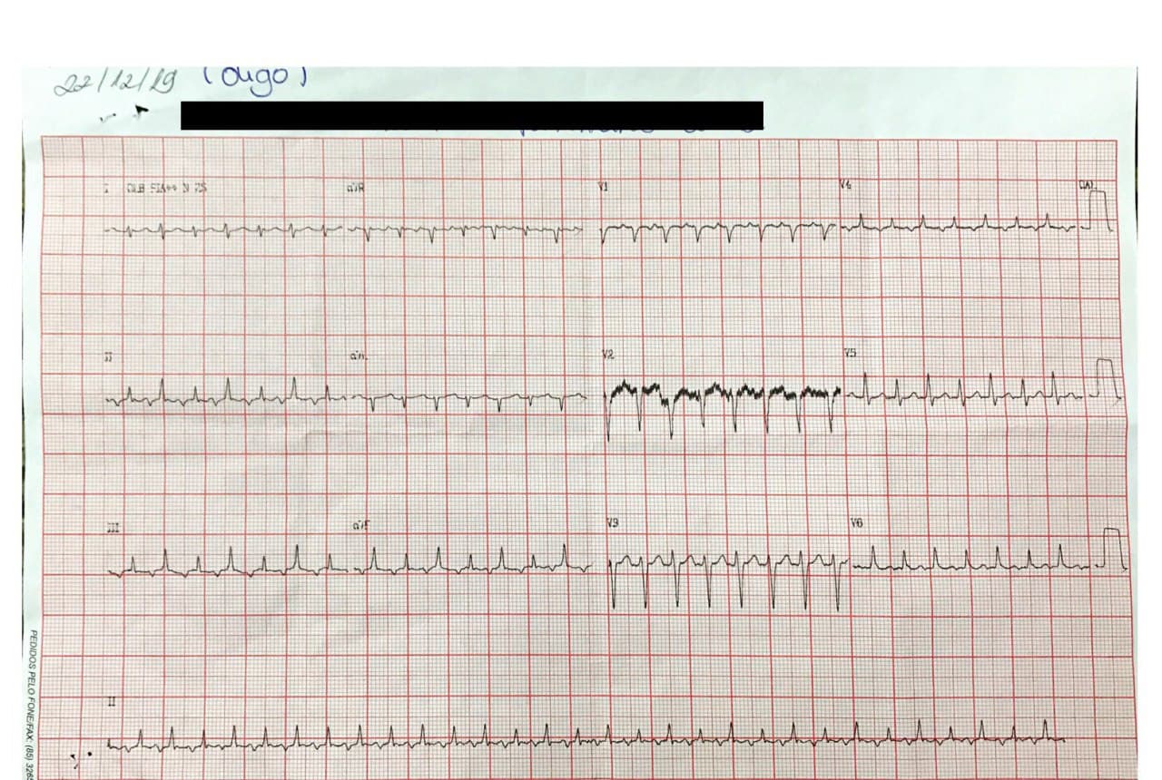 Mujer de 31 años con palpitaciones que presenta una taquicardia de QRS estrecho que termina con la inyección de adenosina