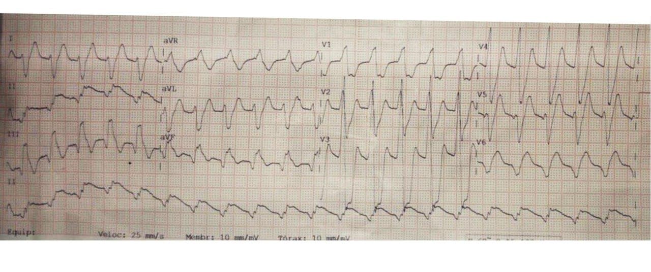 Hombre de 50 años HTA con cuadro de angor prolongado y disnea que presenta TVMS por compromiso de la Cx