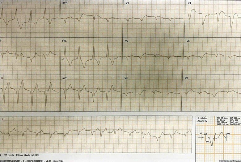 Masculino de 62 años an ángor intenso de reciente comienzo acompañado de síntomas vagales, palpitaciones por presencia de suboclusión con trombo de DA y signos de reperfusión espontánea evidenciada por RIVA